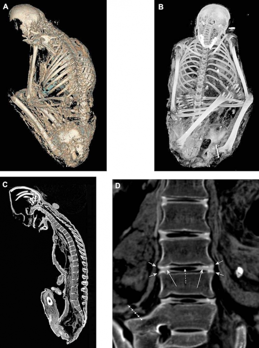 The Inca mummies of sacrificed children and women The Inca mummies of sacrificed children and women