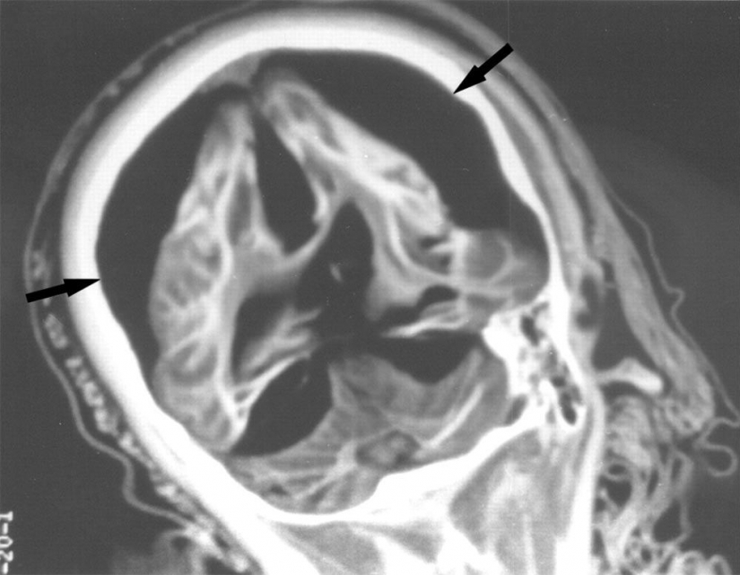 The Inca mummies of sacrificed children and women The Inca mummies of sacrificed children and women