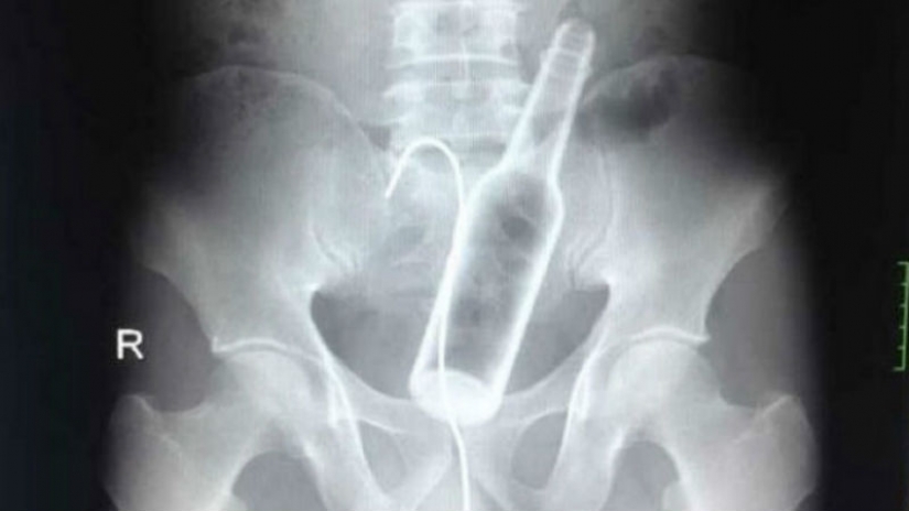 The worst items that have ever found in a human stomach