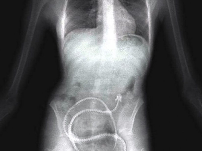 The worst items that have ever found in a human stomach