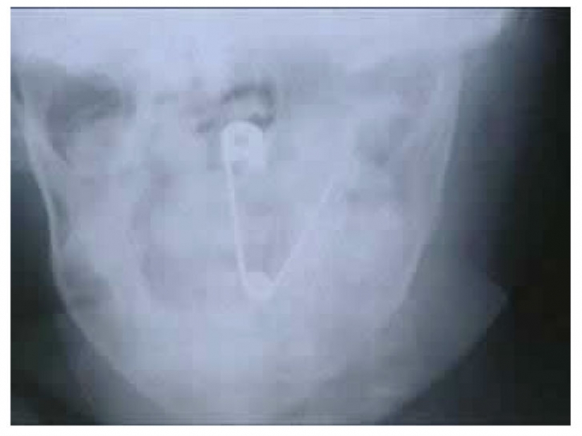 The worst items that have ever found in a human stomach