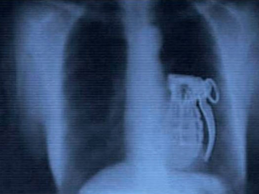 The worst items that have ever found in a human stomach