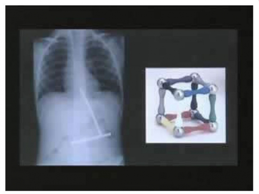 The worst items that have ever found in a human stomach