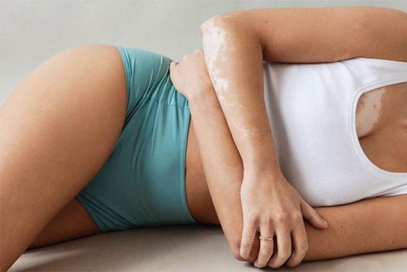 10 beautiful women with vitiligo, photographed by a photographer with the same condition