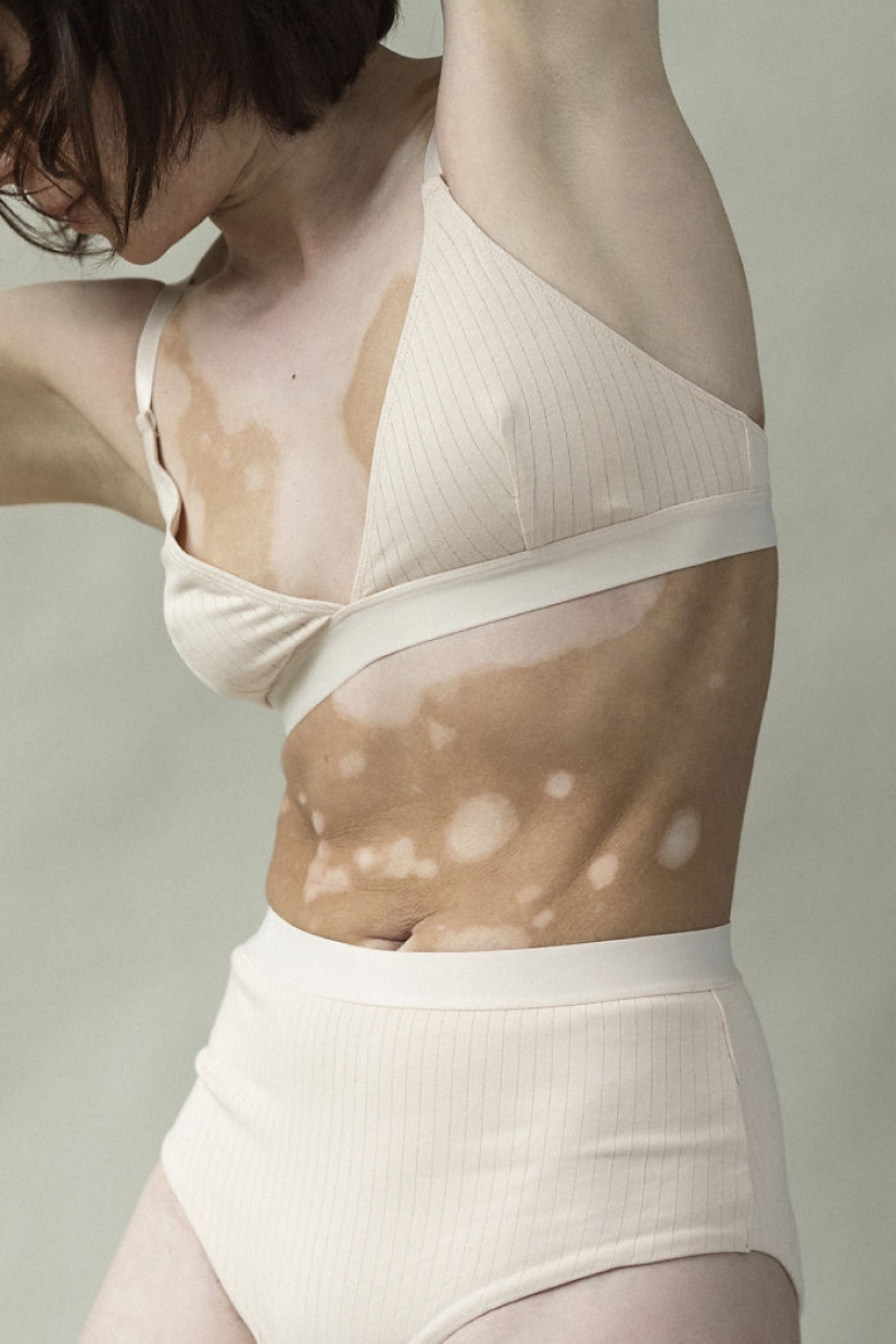 10 beautiful women with vitiligo, photographed by a photographer with the same condition