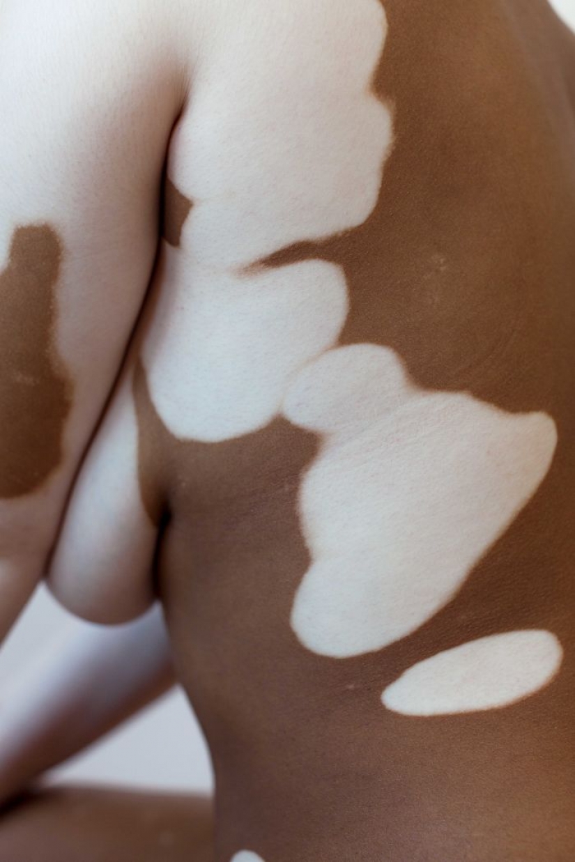 10 beautiful women with vitiligo, photographed by a photographer with the same condition