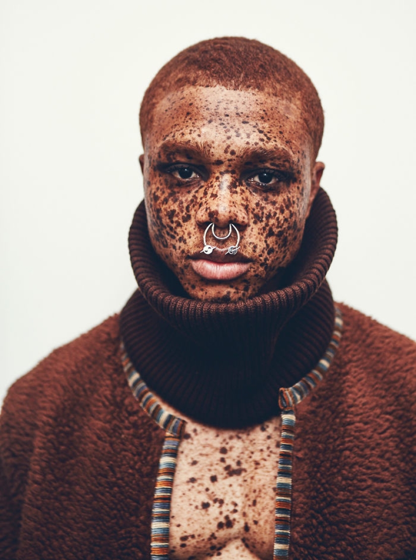 16 fascinating photos of people with freckles