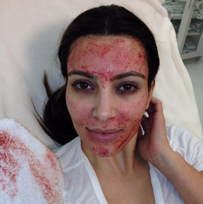 7 horribles procedimientos cosméticos populares en Hollywood