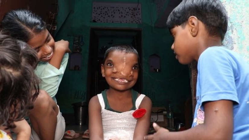 A girl with two noses in India is considered the incarnation of a deity