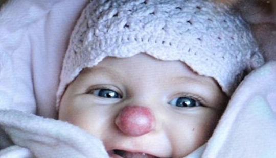 A young British woman who was born with a spot on her nose helps people with flaws in appearance A young British woman who was born with a spot on her nose helps people with flaws in appearance