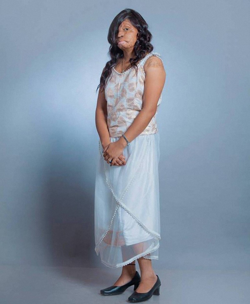 Acid mutilated models from India