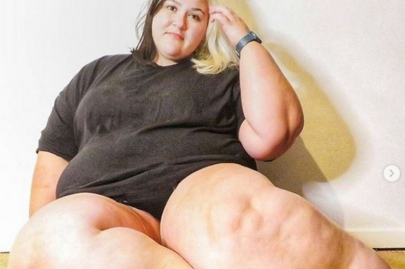 British woman exhausted herself with diets to make her legs lose weight, but it was a disease British woman exhausted herself with diets to make her legs lose weight, but it was a disease