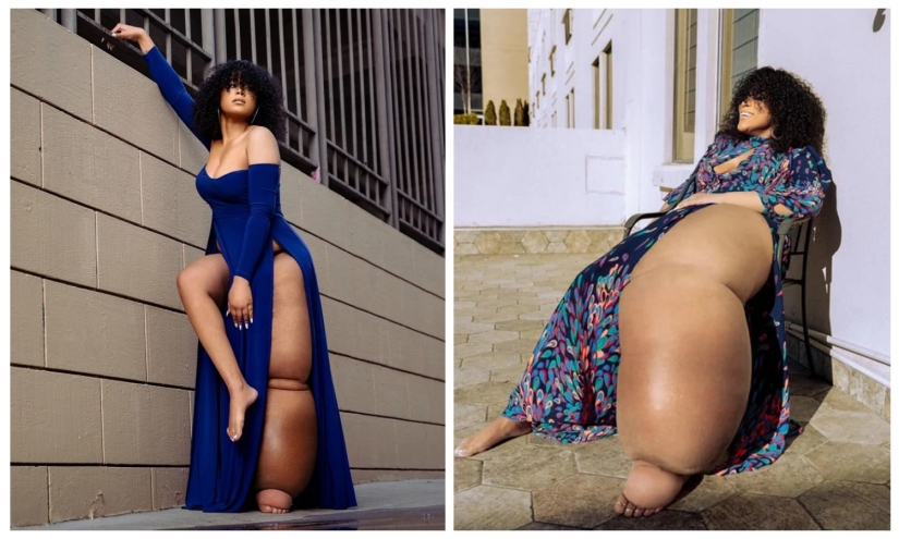 "Cut off your leg!": how an American woman with a 45-kilogram limb learned to love herself