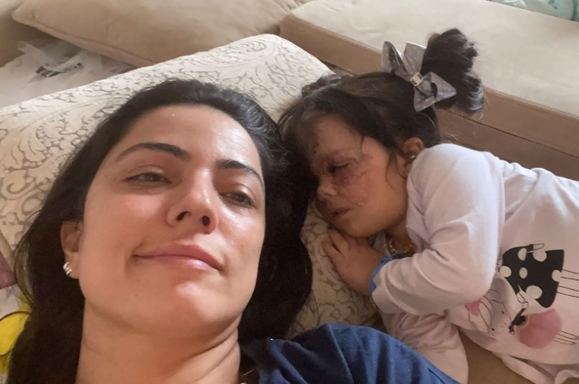 De Batman a Princesa: los médicos rusos eliminaron una enorme marca de nacimiento de la cara de una mujer estadounidense de 2 años