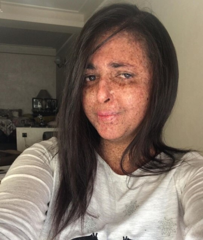 Debido a una rara alergia al sol, una mujer de Marruecos camina en un traje espacial