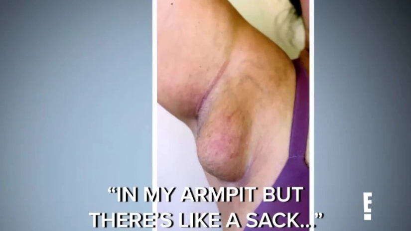 Después de dar a luz, la mujer estadounidense creció "pechos" bajo sus brazos, de los cuales la leche supuraba