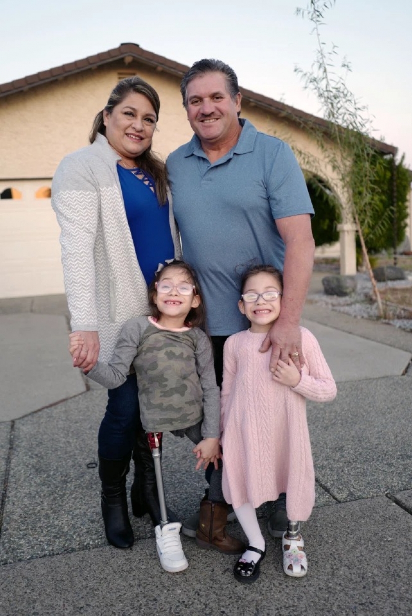Difficult choice: parents from the United States are afraid to make a decision about the separation of Siamese twins