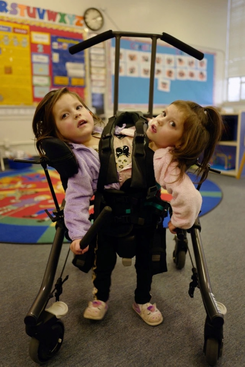 Difficult choice: parents from the United States are afraid to make a decision about the separation of Siamese twins