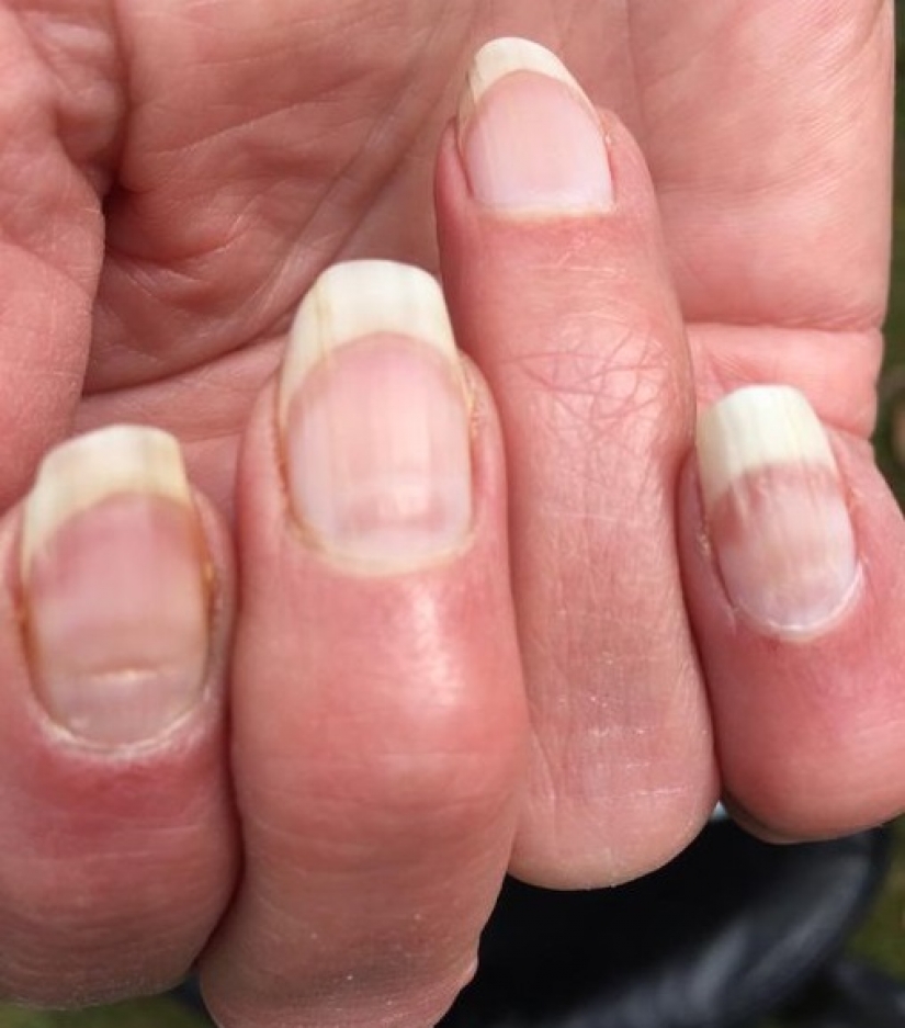 Doctors called an unexpected symptom that you have suffered a coronavirus Doctors called an unexpected symptom that you have suffered a coronavirus