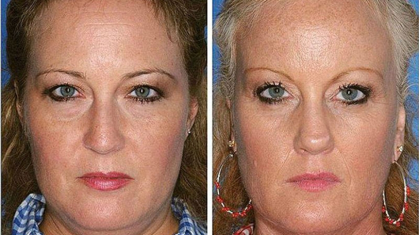 Effects of smoking on the example of twins