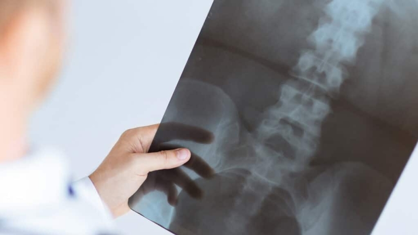 El hombre se decepcionó tanto que casi murió, pero la dieta y los deportes lo salvaron y lo hicieron guapo
