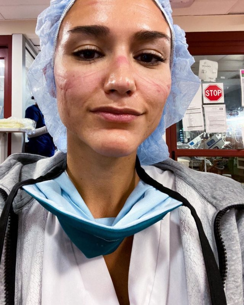 "Estas heridas no desaparecerán, permanecerán dentro de nosotros": fotos de chicas médicas con rastros de máscaras en sus rostros