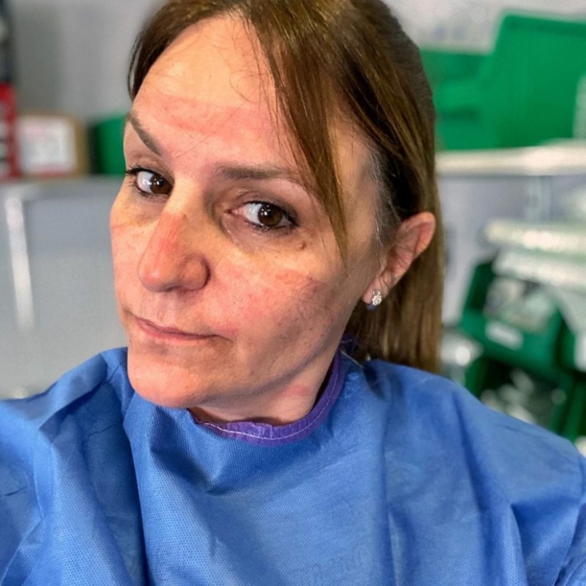 "Estas heridas no desaparecerán, permanecerán dentro de nosotros": fotos de chicas médicas con rastros de máscaras en sus rostros