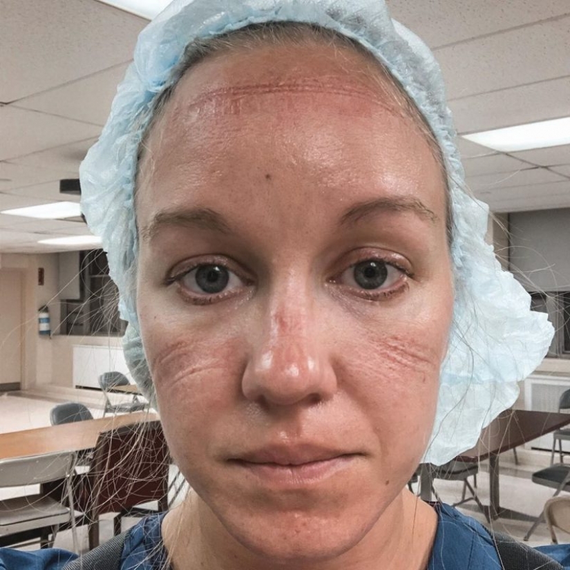 "Estas heridas no desaparecerán, permanecerán dentro de nosotros": fotos de chicas médicas con rastros de máscaras en sus rostros