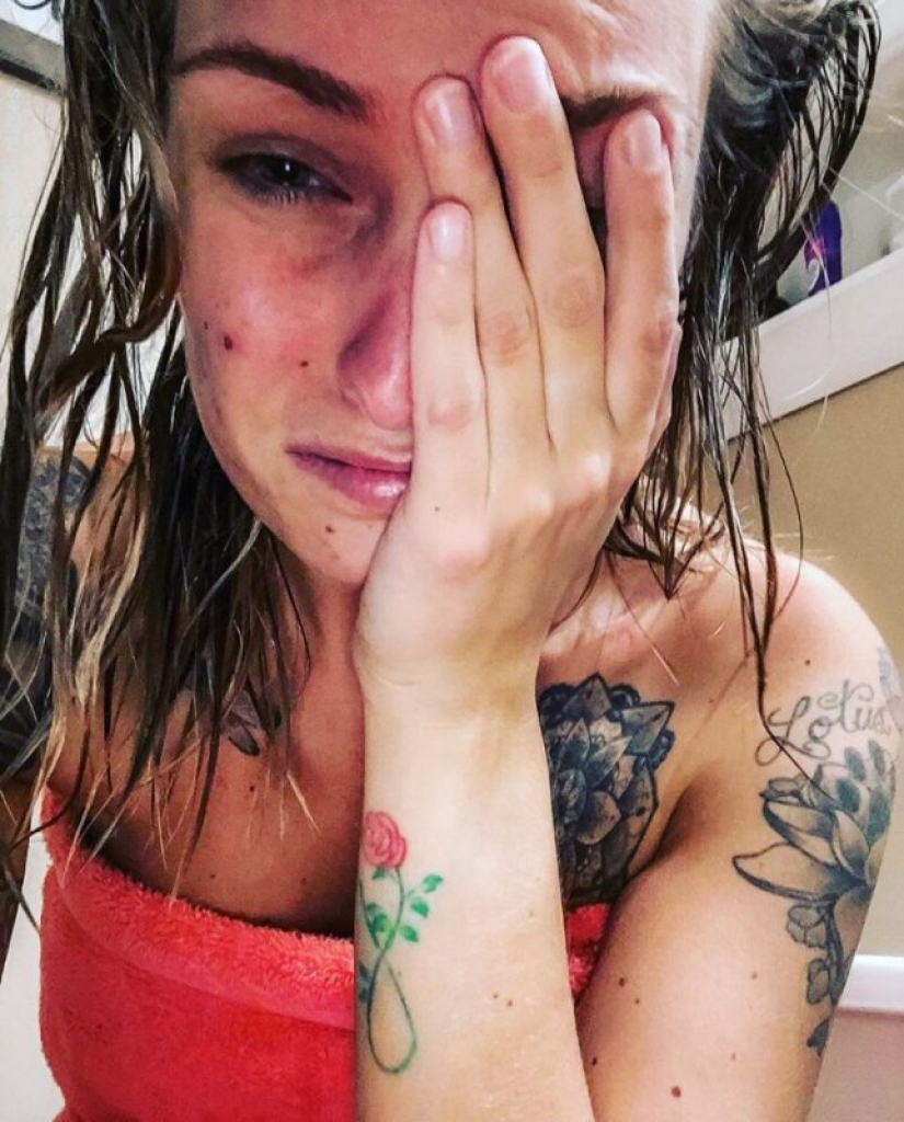 "Estas heridas no desaparecerán, permanecerán dentro de nosotros": fotos de chicas médicas con rastros de máscaras en sus rostros