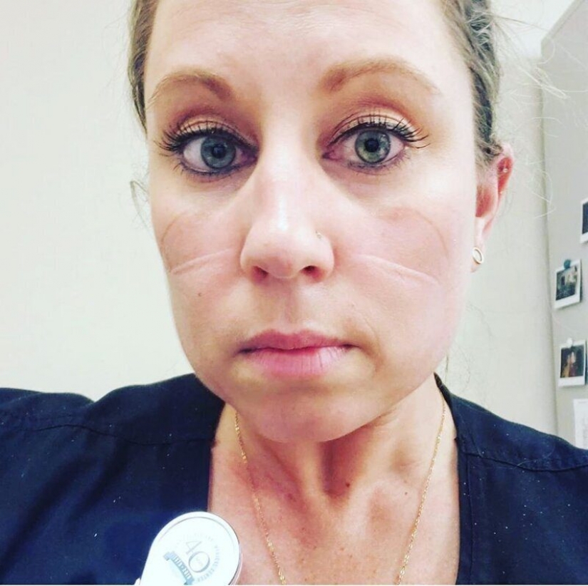 "Estas heridas no desaparecerán, permanecerán dentro de nosotros": fotos de chicas médicas con rastros de máscaras en sus rostros