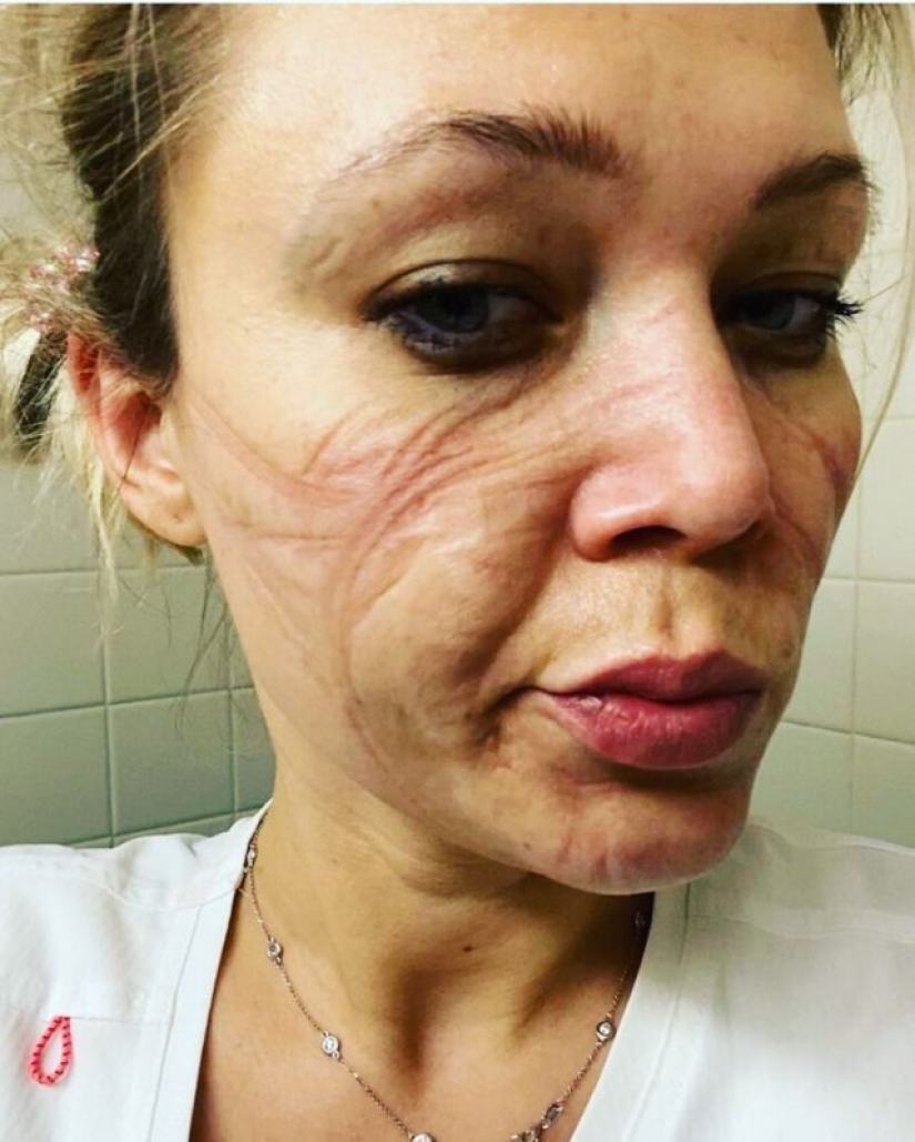 "Estas heridas no desaparecerán, permanecerán dentro de nosotros": fotos de chicas médicas con rastros de máscaras en sus rostros
