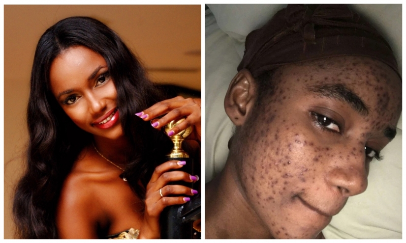 Fatal la atención: el modelo de las reclamaciones que Suiza de cosméticos arruinó la piel y de la carrera