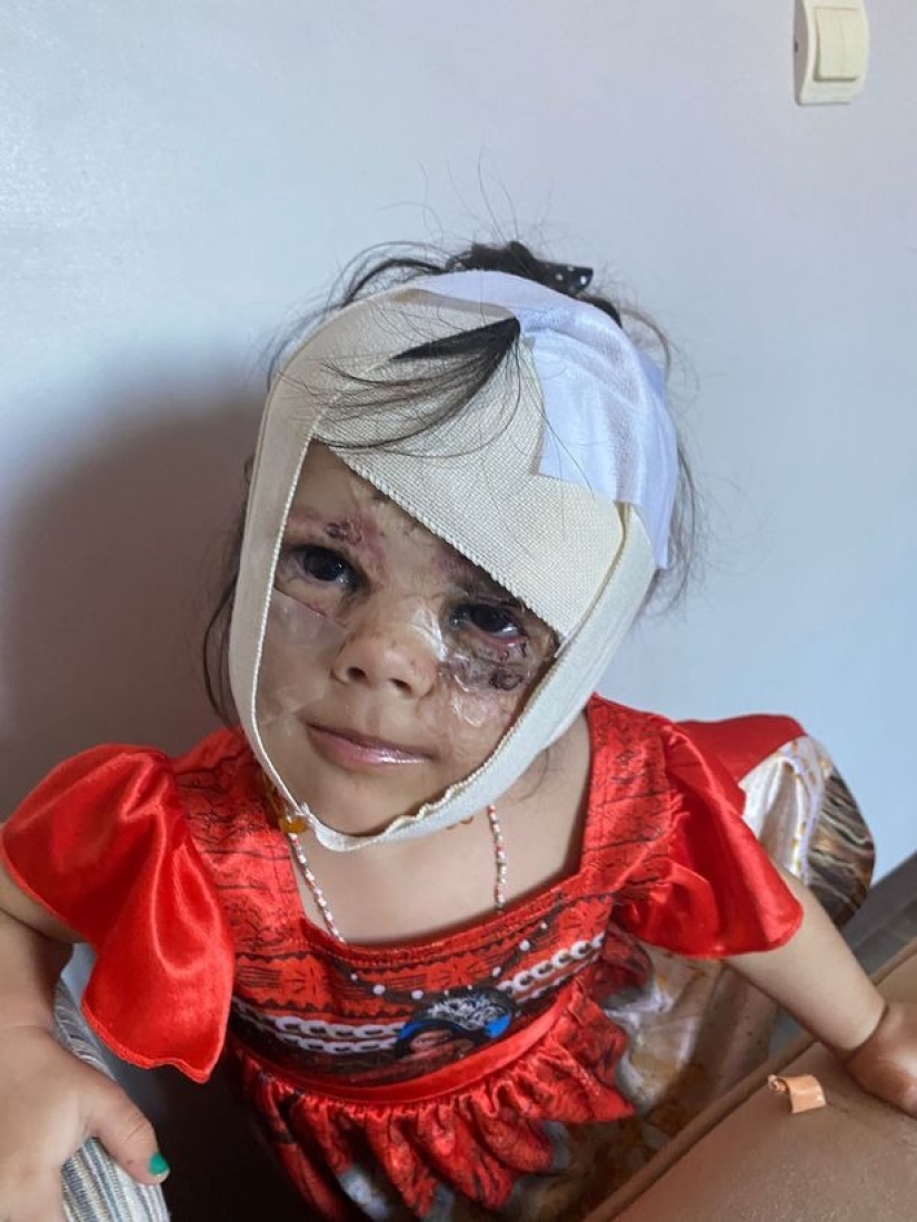 From Batman to Princess: Russian doctors removed a huge birthmark from the face of a 2-year-old American woman