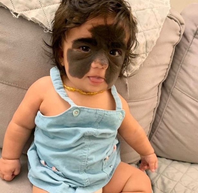 From Batman to Princess: Russian doctors removed a huge birthmark from the face of a 2-year-old American woman