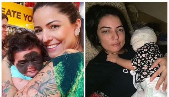 From Batman to Princess: Russian doctors removed a huge birthmark from the face of a 2-year-old American woman