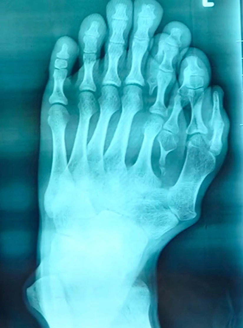 Happiness is never too much: the Chinese have long lived with 14 toes, considering the anomaly of happy sign