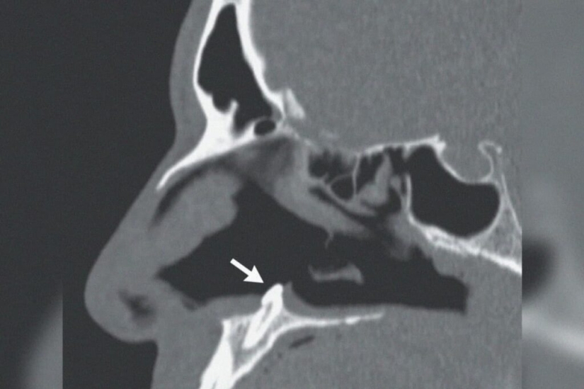 In the USA, surgeons removed a tooth that grew in a man's nose In the USA, surgeons removed a tooth that grew in a man's nose