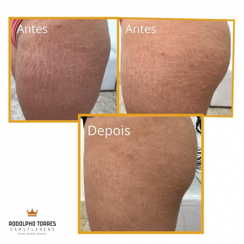 Instead of surgeons and creams: a Brazilian tattoo artist gets rid of stretch marks in an unconventional way