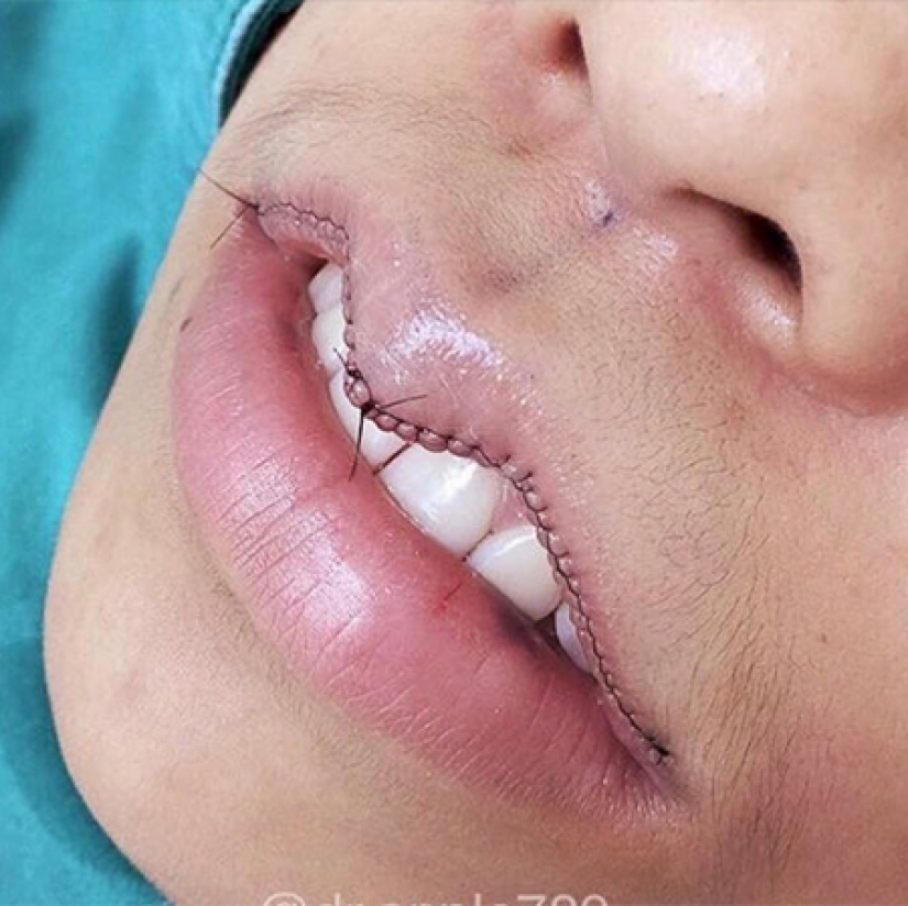 "Labios de cereza", reducción de mandíbula, fosas nasales de plástico: ¿qué operaciones son populares en Corea del Sur