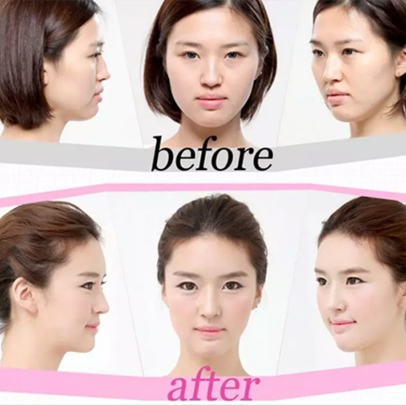 "Labios de cereza", reducción de mandíbula, fosas nasales de plástico: ¿qué operaciones son populares en Corea del Sur