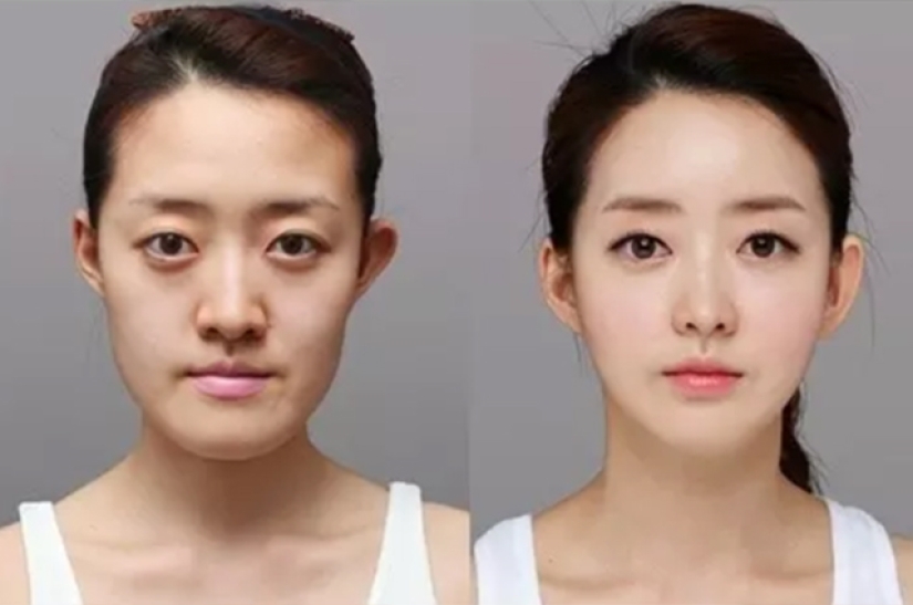 "Labios de cereza", reducción de mandíbula, fosas nasales de plástico: ¿qué operaciones son populares en Corea del Sur