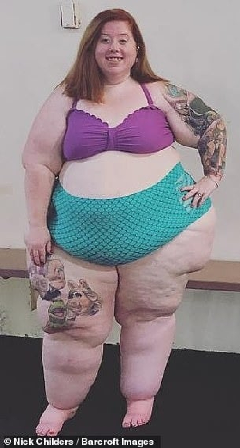 Not overeating, but a disease: an American woman is struggling with lipedema with the help of operations Not overeating, but a disease: an American woman is struggling with lipedema with the help of operations