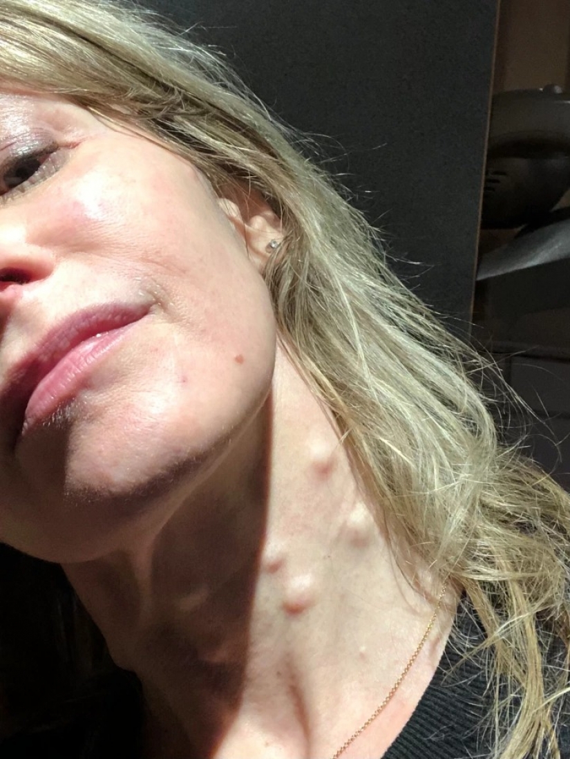 On her own skin: the British woman experienced the effects of fashionable cosmetic procedures