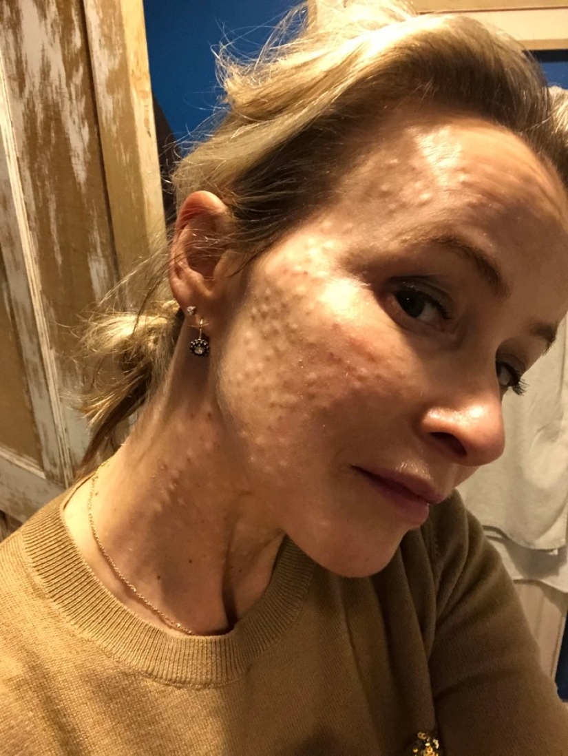 On her own skin: the British woman experienced the effects of fashionable cosmetic procedures