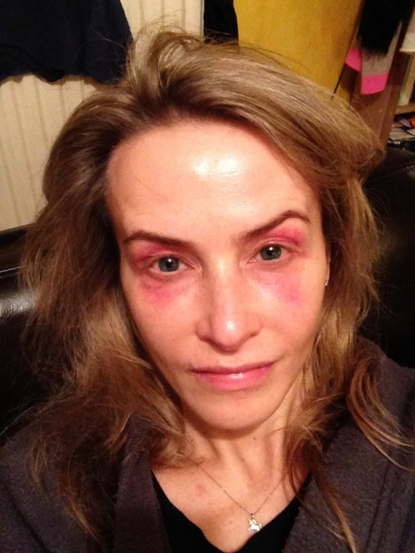 On her own skin: the British woman experienced the effects of fashionable cosmetic procedures