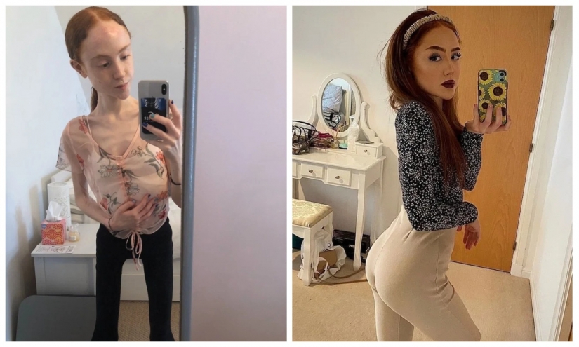 On the edge of the abyss: how a young Scottish woman weighing 25 kg was able to overcome anorexia