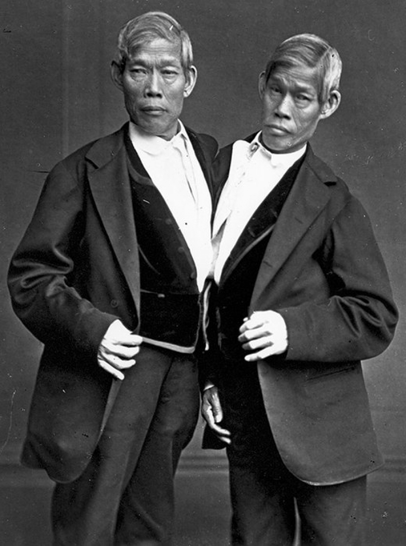 One life for two people without strain and tragedies: a happy Siamese twins One life for two people without strain and tragedies: a happy Siamese twins