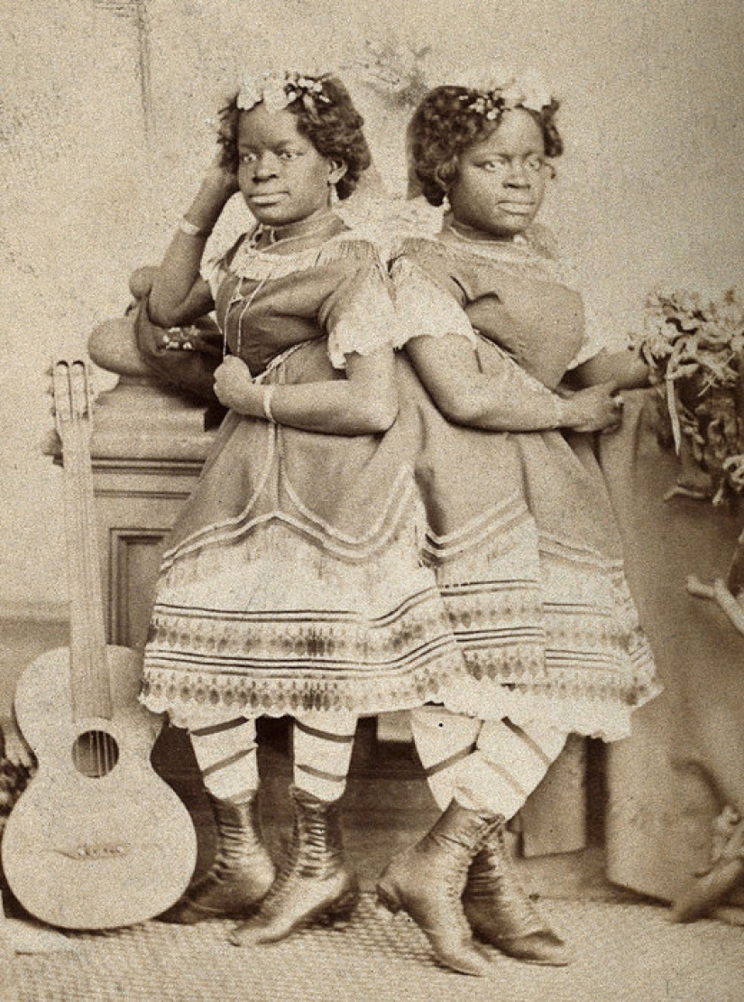 One life for two people without strain and tragedies: a happy Siamese twins One life for two people without strain and tragedies: a happy Siamese twins