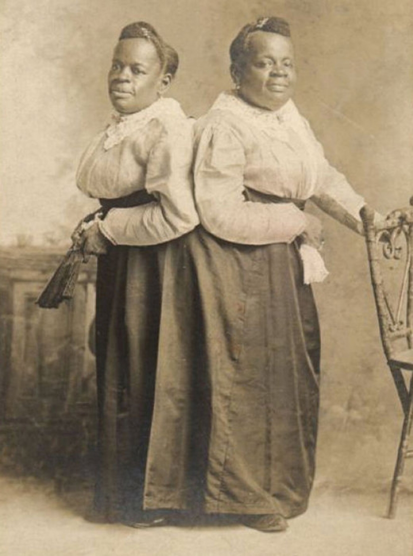 One life for two people without strain and tragedies: a happy Siamese twins One life for two people without strain and tragedies: a happy Siamese twins