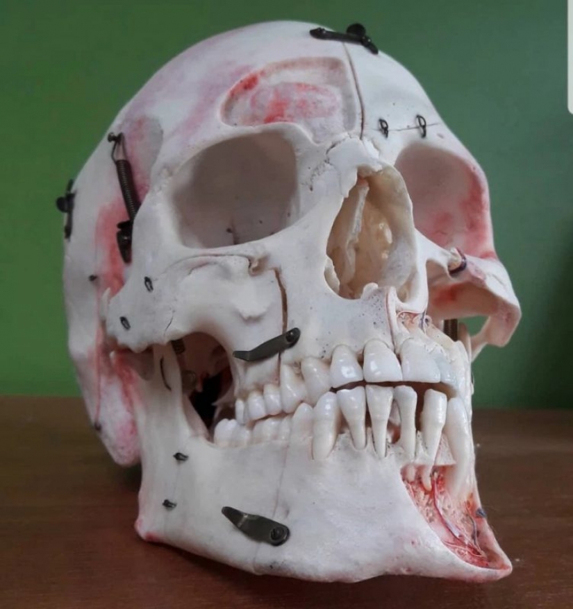 Recuento de hueso? En el mercado negro Instagram aparecido restos humanos